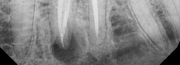 Что такое киста и кистогранулема зуба? виды, симптомы, методы лечения
