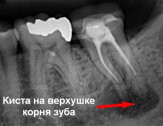 Удаление зуба с кистой на корне