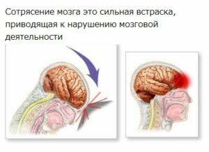 Сотрясение мозга | симптомы | диагностика | лечение - docdoc.ru