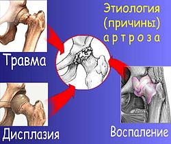 Полиостеоартроз: течение болезни и принципы лечения - нолтрекс. препарат для лечения остеоартроза, артроза, артрита, остеоартрита и других болезней суставов