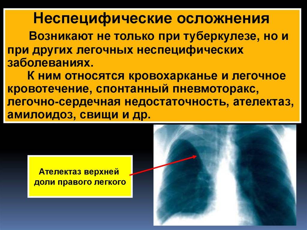 Клиническая картина туберкулеза легких