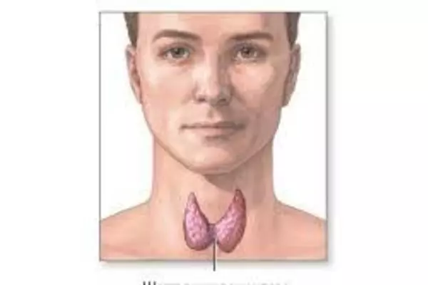 Зоб щитовидной железы - симптомы и лечение