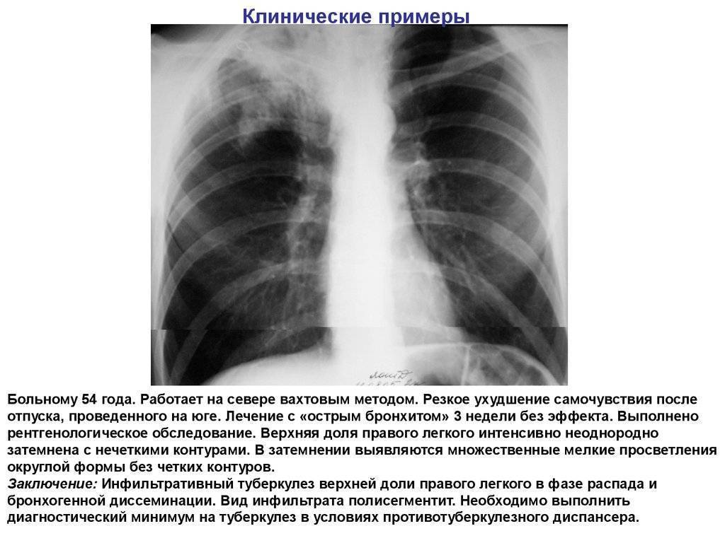 Признаки и способы лечения казеозной пневмонии при туберкулезе