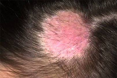 Микроспория у человека - причины возникновения, проявления на коже и волосистой части головы, методы лечения