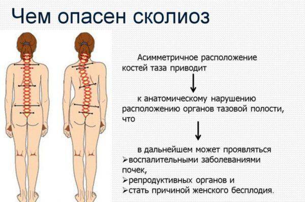 Умирают ли от искривления позвоночника?