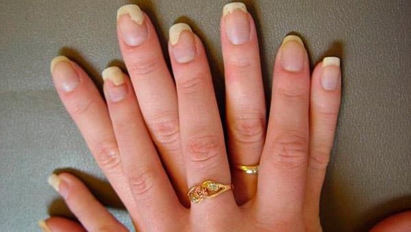 Грибок ногтей на руках — признаки и симптомы + фото, методы лечения