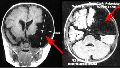 Ликворная (арахноидальная) киста головного мозга: симптомы, лечение и перспективы для пациента