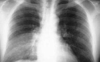 Как отличить пневмонию от туберкулеза легких