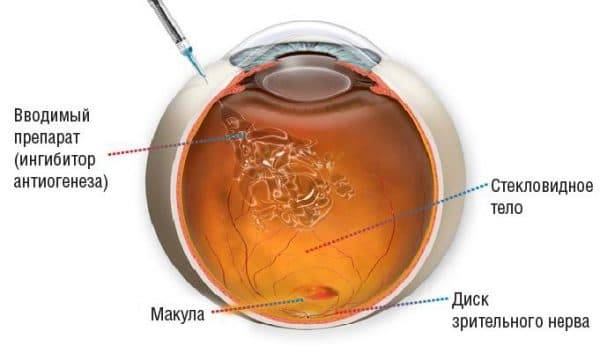 Лечение кровоизлияния в стекловидное тело, в глаз