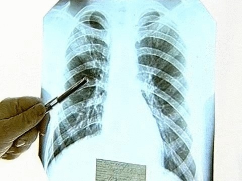 Лечение туберкулеза химиотерапией