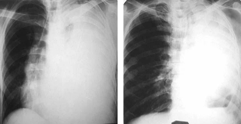 Рентгенологическое исследование при туберкулёзе