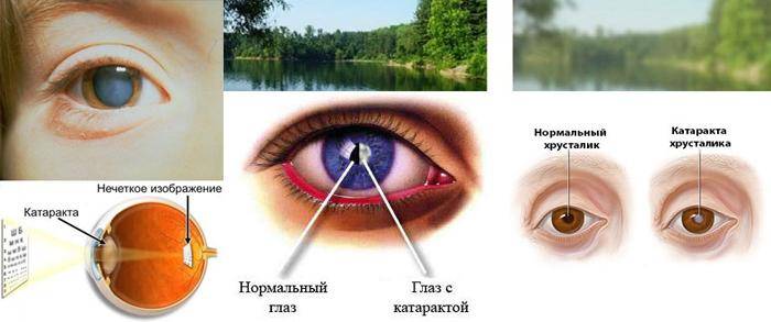 Глазные капли Скулачева: инструкция по применению