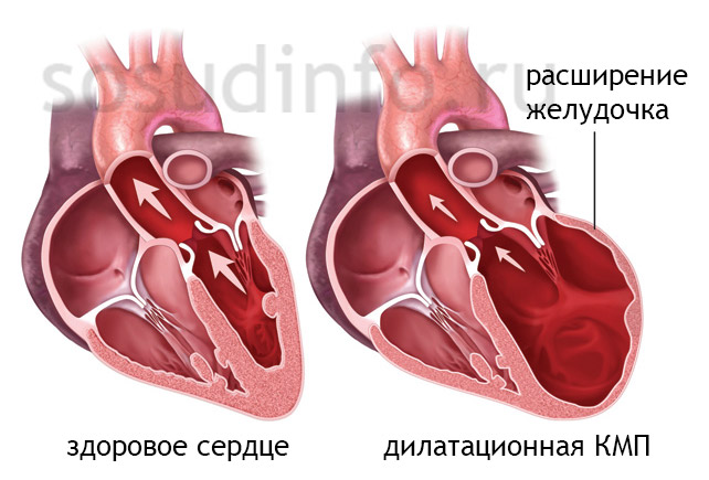 Гипертрофия левого желудочка сердца