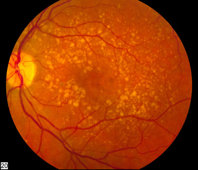 Макулодистрофия сетчатки глаза – лечение и методы профилактики