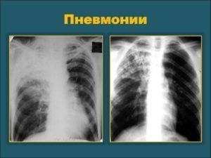 Чем бронхопневмония отличается от пневмонии?