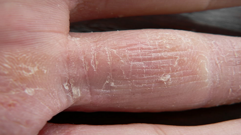 Как справиться с грибком на пальцах рук: методы лечения