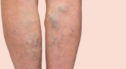 Трофические язвы на ногах. фото, лечение, почему образуются, чем мазать