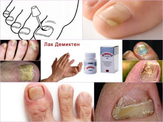 Ногтивит от грибка ногтей — отзывы, цена, аналоги