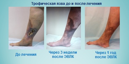 Профилактика трофических язв на ногах