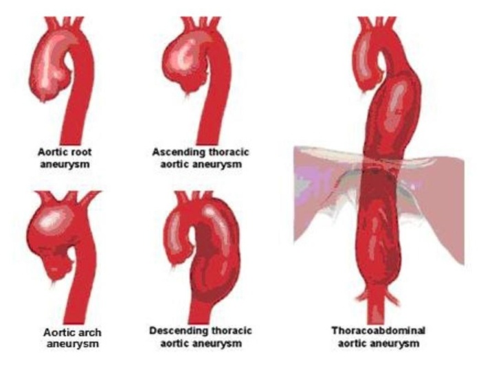 Болезнь, которая успешно маскируется — аневризма восходящего отдела аорты
