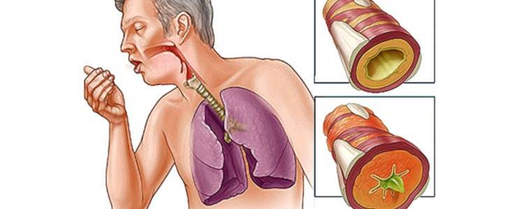 Лабораторные методы диагностики бронхиальной астмы - анализ мокроты