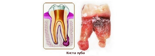 Способы удаления кисты зуба и восстановление десны после операции