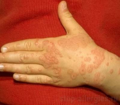 Аллергия на пыль: симптомы, лечение, у ребенка, сыпь, таблетки, при беременности, фото, кашель, причины