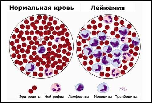 Рак крови: разновидности заболевания, методы диагностики и лечения
