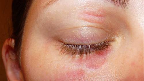 Контактная аллергия: причины возникновения реакции, специфические симптомы и методы лечения