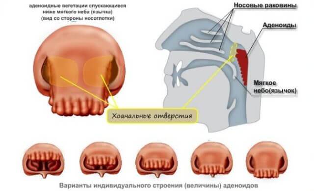 Гипертрофия миндалин у ребенка фото