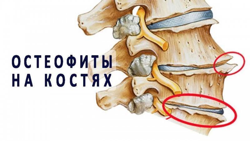 Удалить остеофиты на позвоночнике