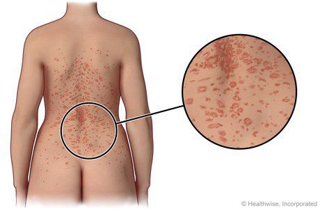 Розовый лишай – причины, симптомы и лечение болезни жибера