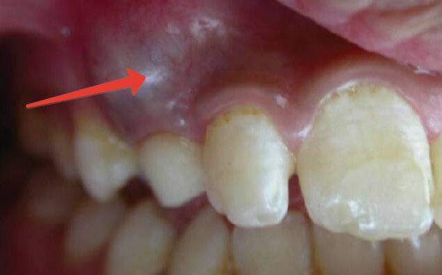Киста и гранулема зуба причины симптомы диагностика лечение