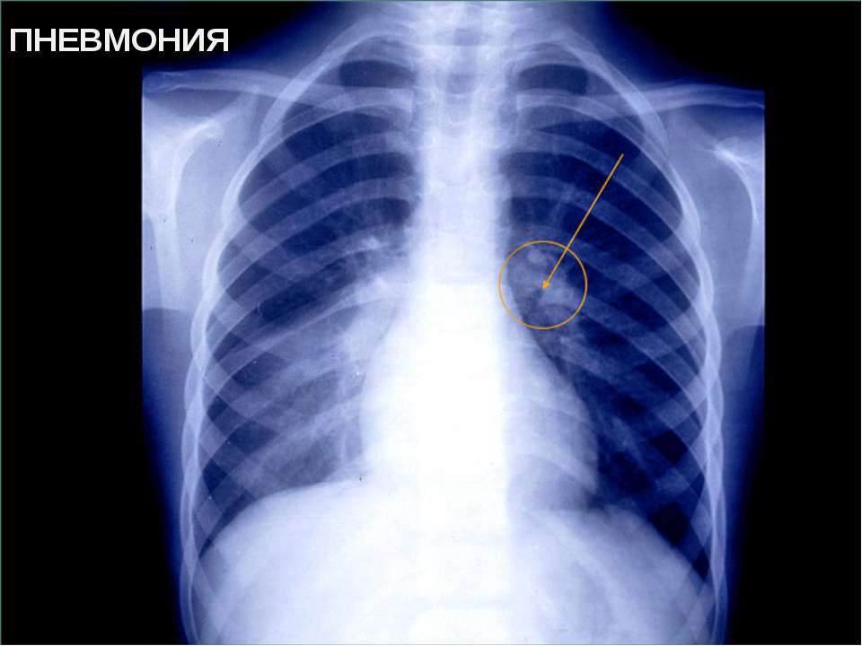 Боль в грудной клетке при кашле после пневмонии