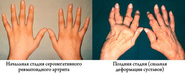 Ревматоидный артрит. причины, симптомы, диагностика
