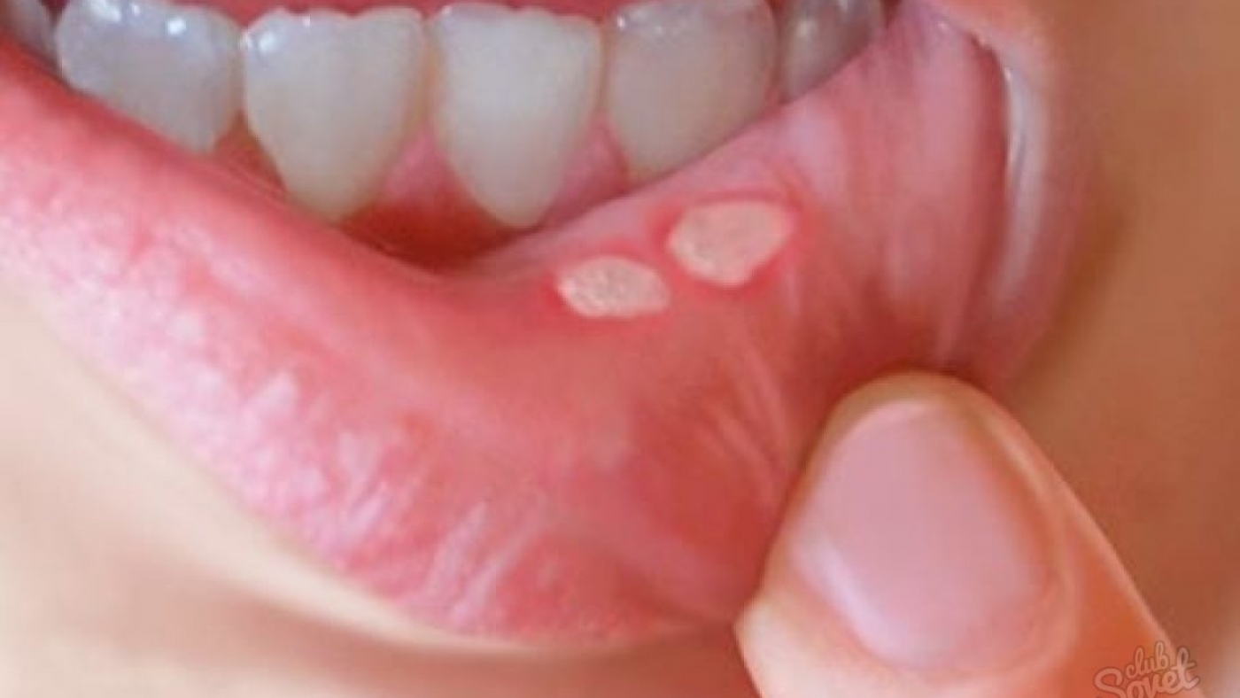 Язвы во рту: почему появляются и способы лечения - много зубов