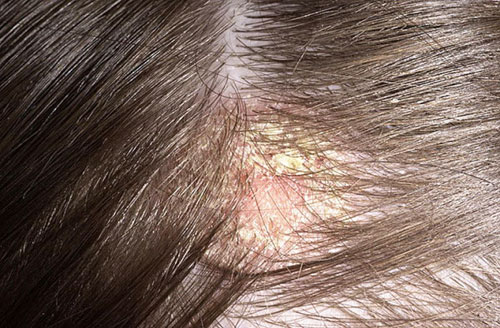 Грибок кожи головы: симптомы, как и чем лечить