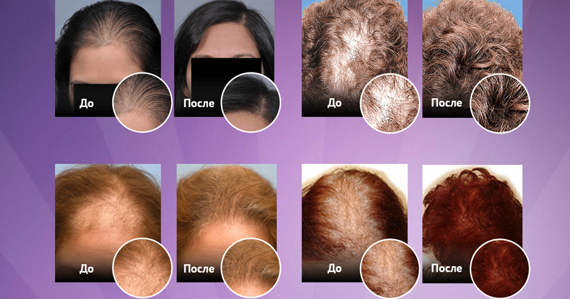 Миноксидил для волос и роста бороды (kirkland): стоимость, отзывы