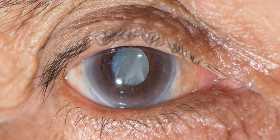 Если внутриглазное давление в норме может ли быть глаукома
