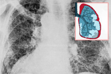 Что такое фиброз лёгких и чем он опасен?