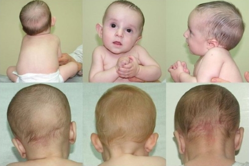 Признаки кривошеи - кривошея у ребенка 2 месяца фото - запись пользователя анастасия (nastalgiya) в сообществе здоровье новорожденных в категории кривошея - babyblog.ru