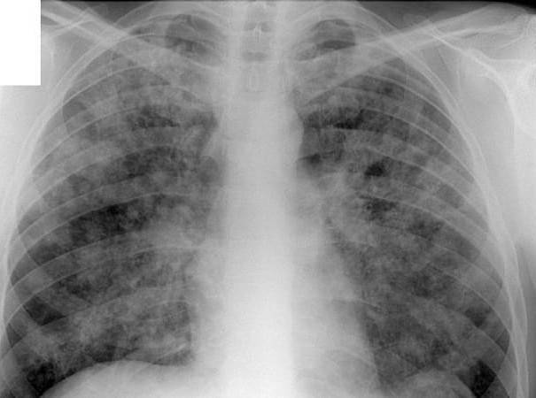Открытая форма туберкулеза легких