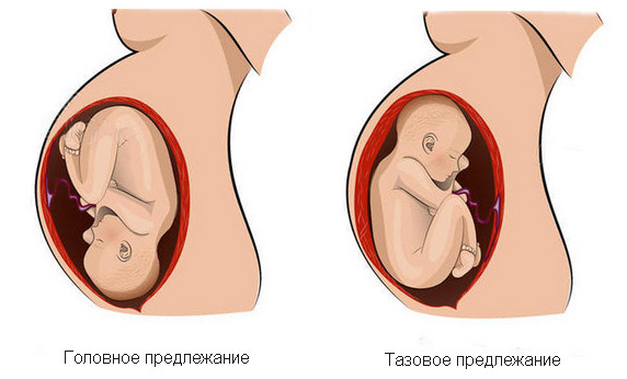 Симфизит при беременности
