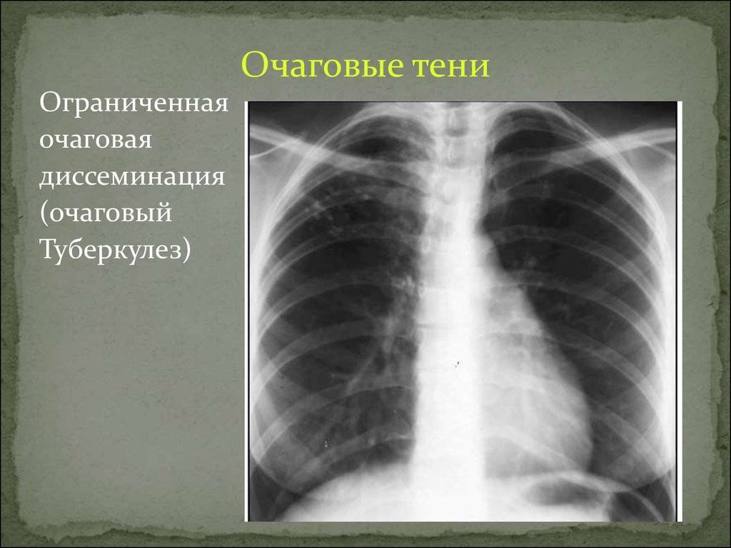 Усилен легочный рисунок на флюорографии что это может быть