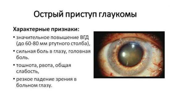 Глаукома: симптомы и лечение, что это такое - открытоугольная и закрытоугольная, признаки и острый приступ, профилактика, лечение