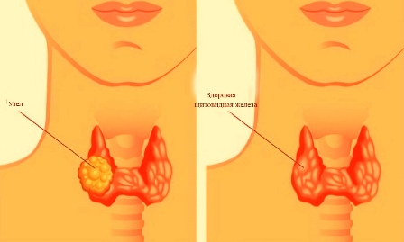 Какие причины провоцируют узловой зоб щитовидной железы 2 степени, основные симптомы и методы лечения?