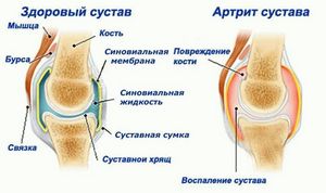 Болеутоляющая мазь «випросал» с ядом гадюки помогает при артрозах, остеохондрозах и невралгии