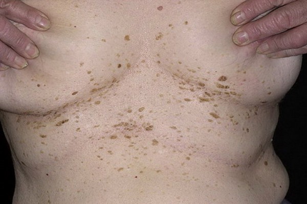 Кератоз кожи. фото у взрослых на лице, теле. причины, стадии, симптомы и лечение