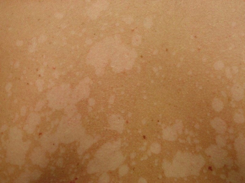Грибковые заболевания кожи: фото, симптомы, названия видов микоза, методы лечения