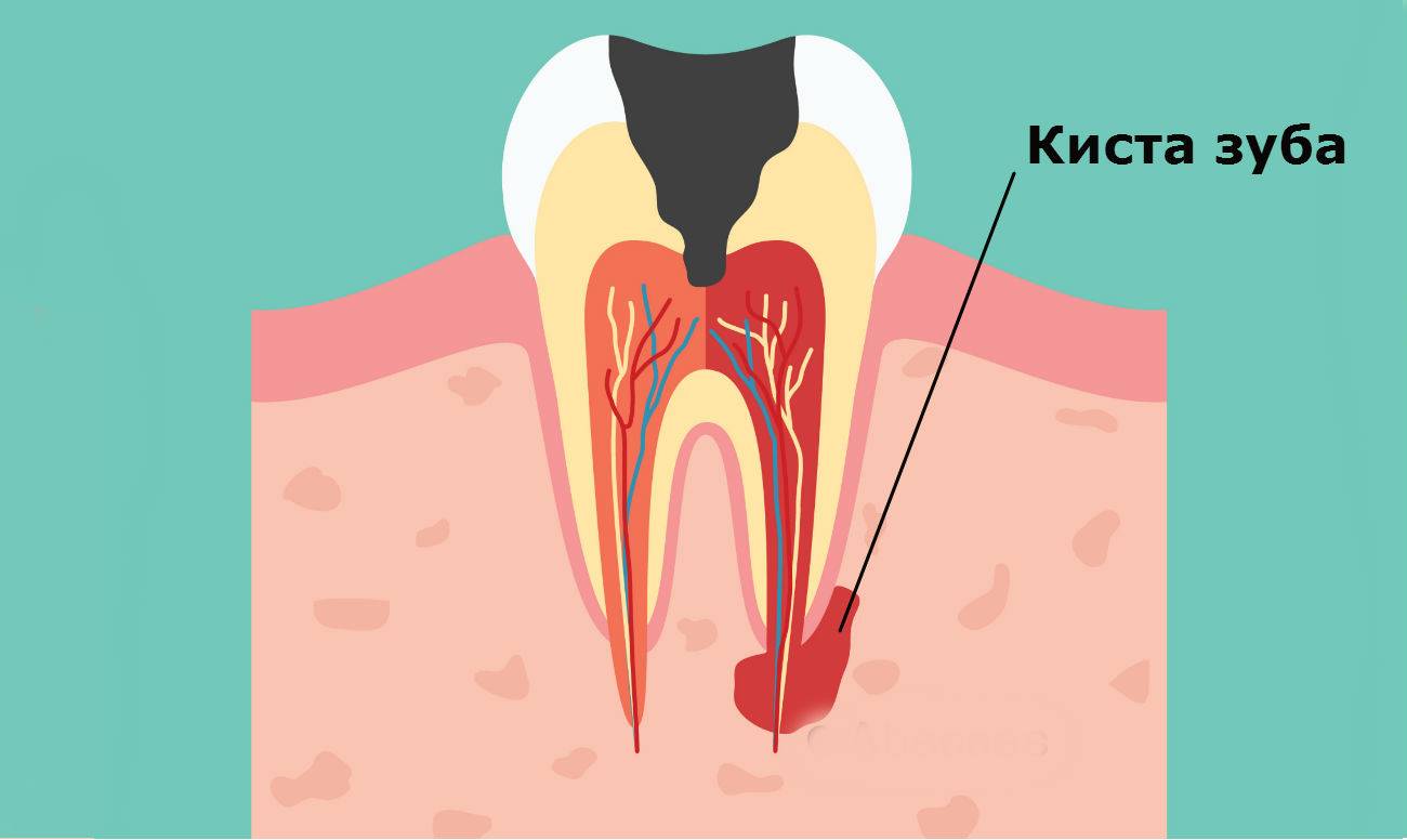 Киста зуба: каковы причины ее появления и как ее лечить?